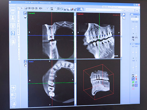 過剰歯の抜歯もおまかせください～3DCTを用いた安全かつ精度の高い治療～