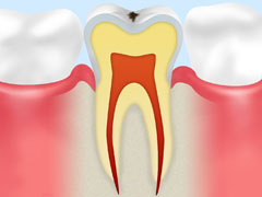 初期の虫歯：CO