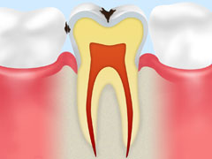 エナメル質の虫歯：C1