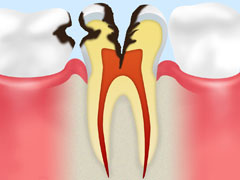 象牙質の虫歯：C2
