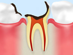 神経に達した虫歯：C3