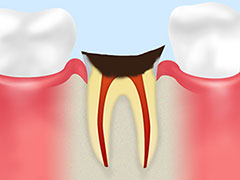 歯根に達した虫歯：C4
