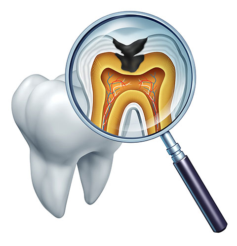 重度の虫歯を救う「根管治療」