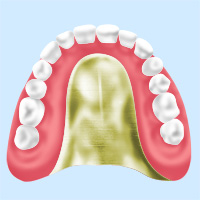 インプラントオーバーデンチャーほかさまざまな入れ歯にも対応