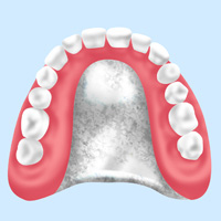 インプラントオーバーデンチャーほかさまざまな入れ歯にも対応