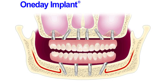 ワンデイインプラント（R)とは？