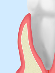 歯周ポケットそうは術